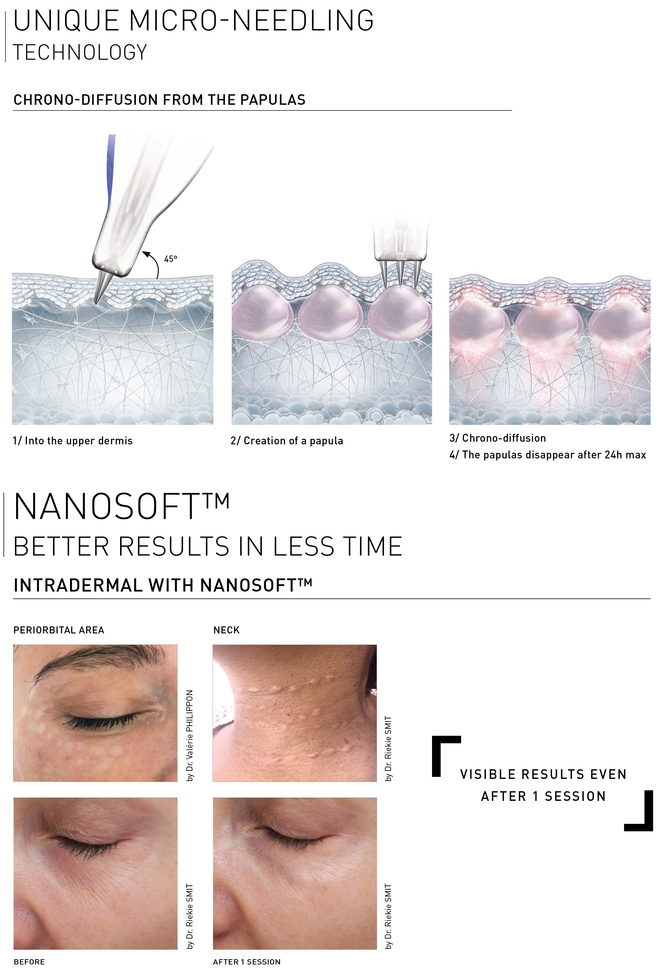 Fillmed Nanosoft Micro-aiguilles 0,6 mm 30 pièces.