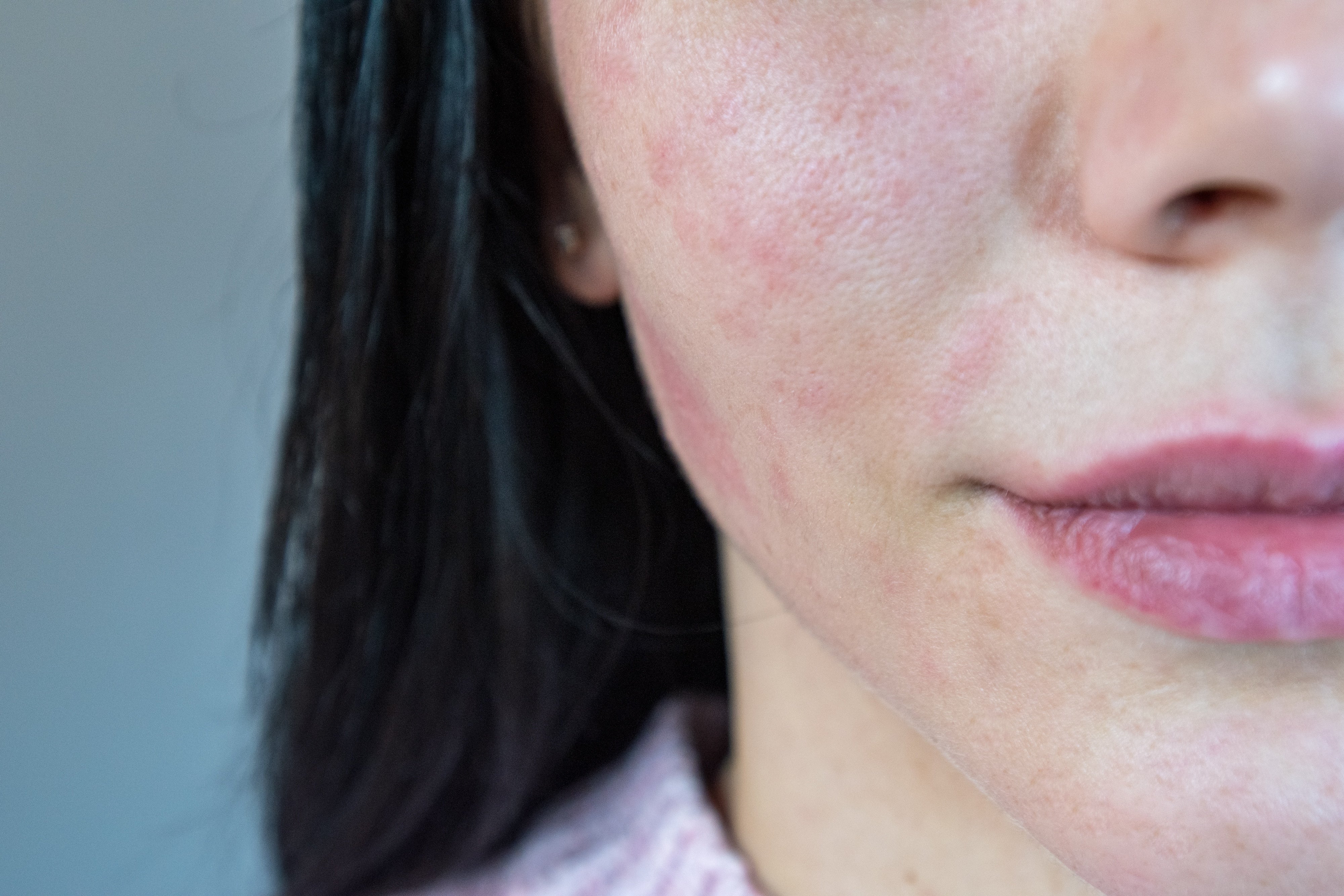 Rosacea