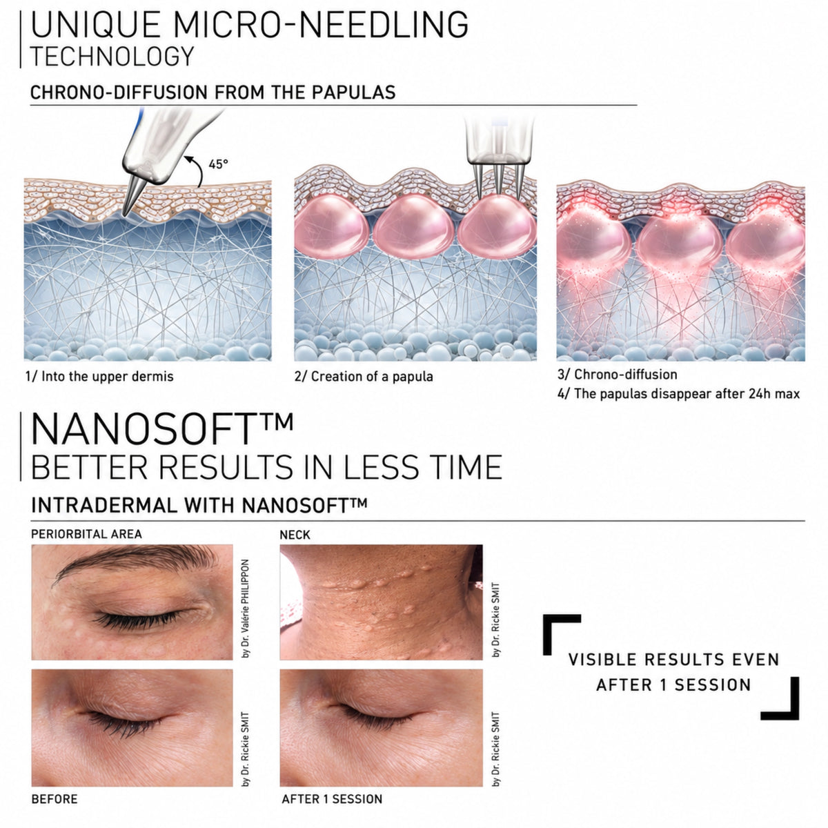 Fillmed Nanosoft Microneedles 0,6mm 30 Stk. | Jetzt mit neuer Verpackung - Jolifill.de